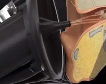 voldic electronic ear wax removal